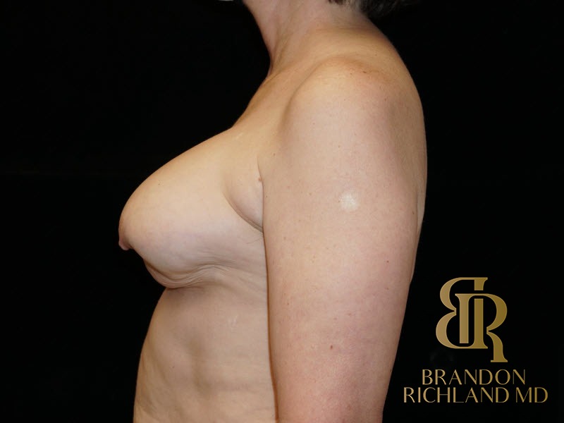 Breast Revision Before, Patient 07, view 3 — Dr. Brandon Richland, Newport Beach