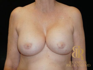 Breast Revision before and after, Patient 16 — Dr. Brandon Richland, Newport Beach