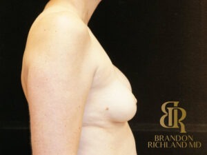 Breast Revision before and after, Patient 16 — Dr. Brandon Richland, Newport Beach