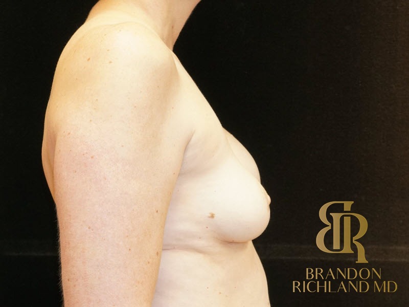 Breast Revision Before, Patient 16, view 3 — Dr. Brandon Richland, Newport Beach