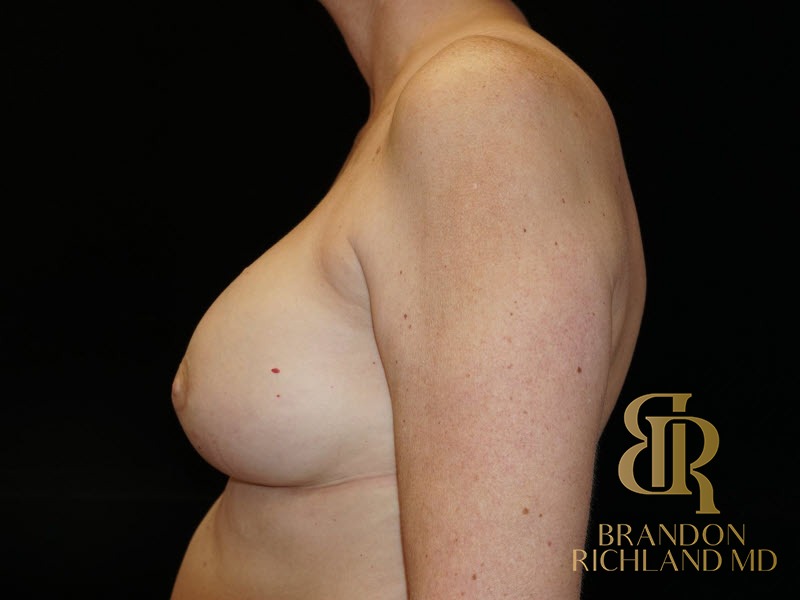 Breast Revision After, Patient 16, view 5 — Dr. Brandon Richland, Newport Beach