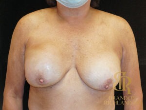 Breast Revision before and after, Patient 19 — Dr. Brandon Richland, Newport Beach