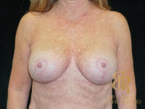 Breast Revision before and after, Patient 23 — Dr. Brandon Richland, Newport Beach