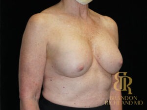 Breast Revision before and after, Patient 24 — Dr. Brandon Richland, Newport Beach