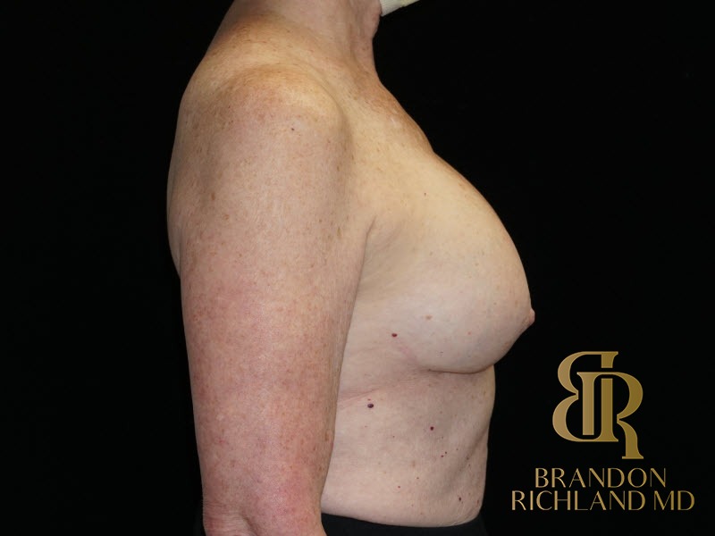 Breast Revision Before, Patient 24, view 3 — Dr. Brandon Richland, Newport Beach