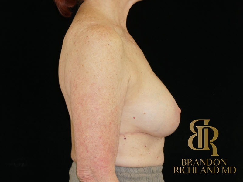 Breast Revision After, Patient 24, view 3 — Dr. Brandon Richland, Newport Beach