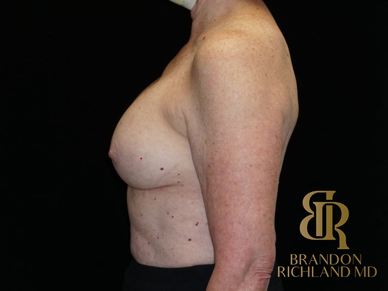 Breast Revision Before, Patient 24, view 5 — Dr. Brandon Richland, Newport Beach