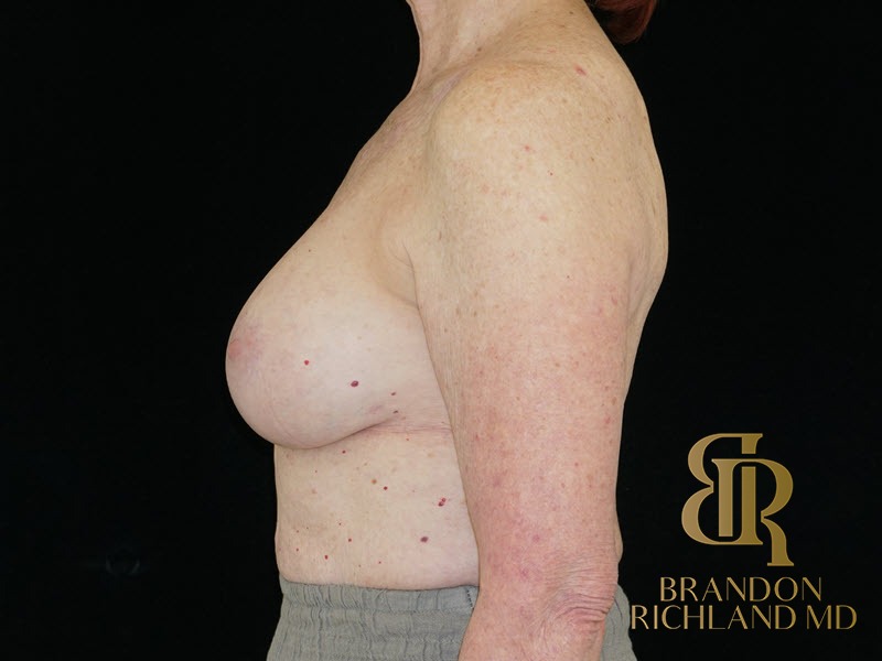 Breast Revision After, Patient 24, view 5 — Dr. Brandon Richland, Newport Beach
