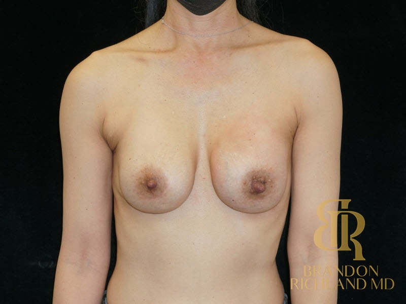 Breast Revision After, Patient 25, view 1 — Dr. Brandon Richland, Newport Beach