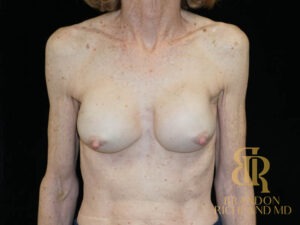 Breast Revision before and after, Patient 28 — Dr. Brandon Richland, Newport Beach