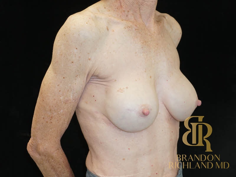 Breast Revision After, Patient 28, view 2 — Dr. Brandon Richland, Newport Beach