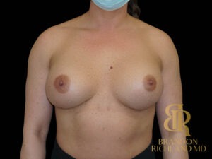 Breast Revision before and after, Patient 30 — Dr. Brandon Richland, Newport Beach
