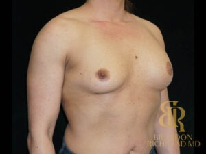 Breast Revision before and after, Patient 30 — Dr. Brandon Richland, Newport Beach