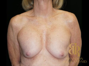 Breast Revision before and after, Patient 32 — Dr. Brandon Richland, Newport Beach