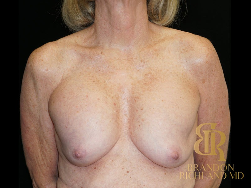 Breast Revision Before, Patient 32, view 1 — Dr. Brandon Richland, Newport Beach