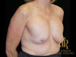 Breast Revision before and after, Patient 32 — Dr. Brandon Richland, Newport Beach