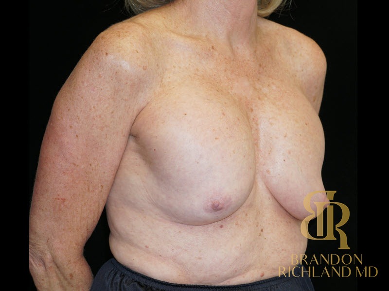 Breast Revision Before, Patient 32, view 2 — Dr. Brandon Richland, Newport Beach