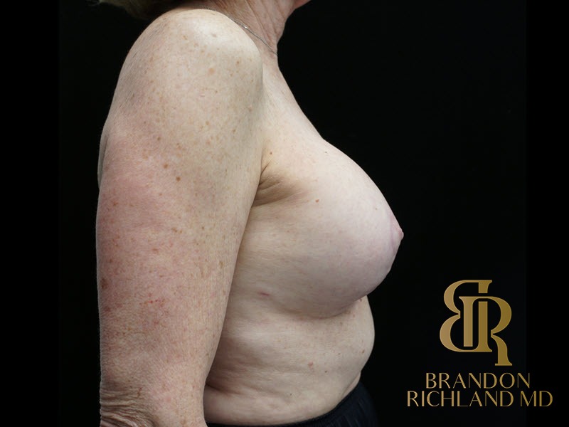 Breast Revision After, Patient 32, view 3 — Dr. Brandon Richland, Newport Beach