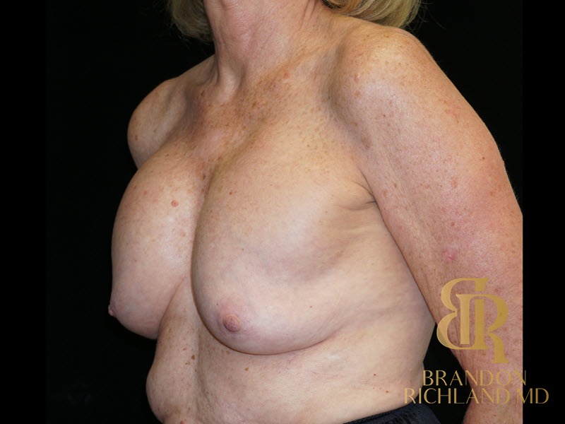 Breast Revision Before, Patient 32, view 4 — Dr. Brandon Richland, Newport Beach