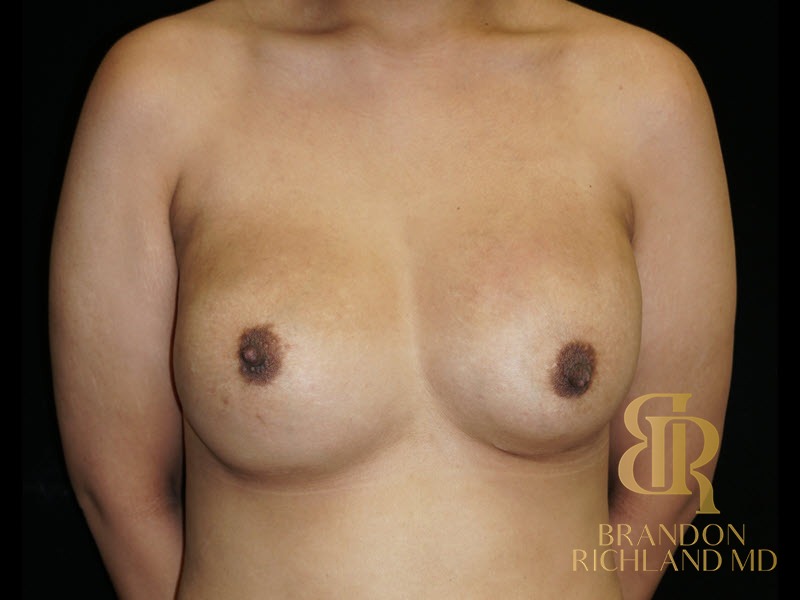 Breast Revision Before, Patient 36, view 1 — Dr. Brandon Richland, Newport Beach