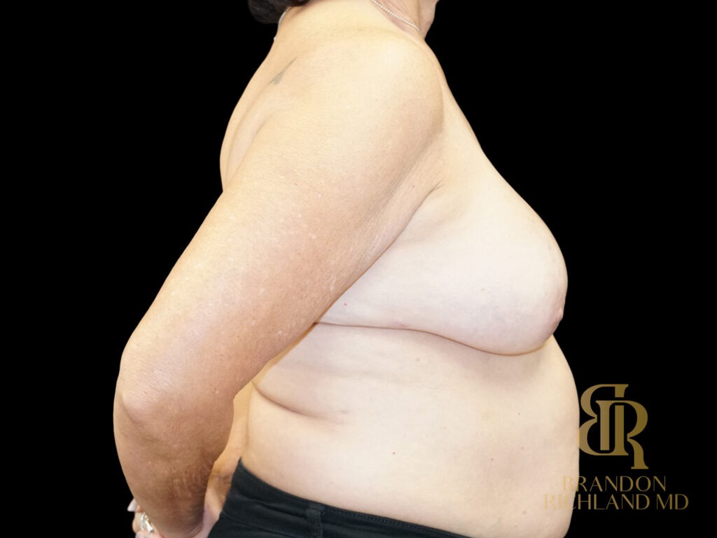 Breast Revision After, Case #59678, view 3 — Dr. Brandon Richland, Newport Beach