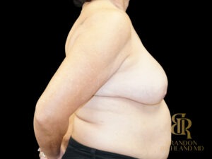 Breast Augmentation before and after, Case #59678 — Dr. Brandon Richland, Newport Beach