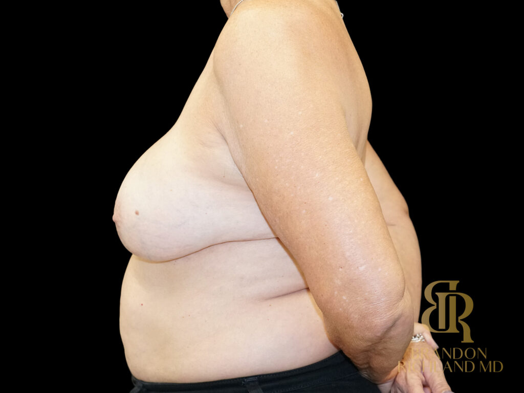 Breast Revision After, Case #59678, view 5 — Dr. Brandon Richland, Newport Beach