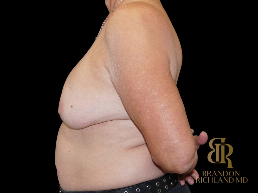 Breast Revision Before, Case #59678, view 5 — Dr. Brandon Richland, Newport Beach
