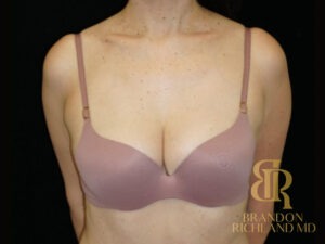 Fat Transfer Breast Augmentation before and after, Patient 02 — Dr. Brandon Richland, Newport Beach
