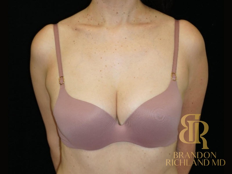Fat Transfer Breast Augmentation After photo, Patient 02