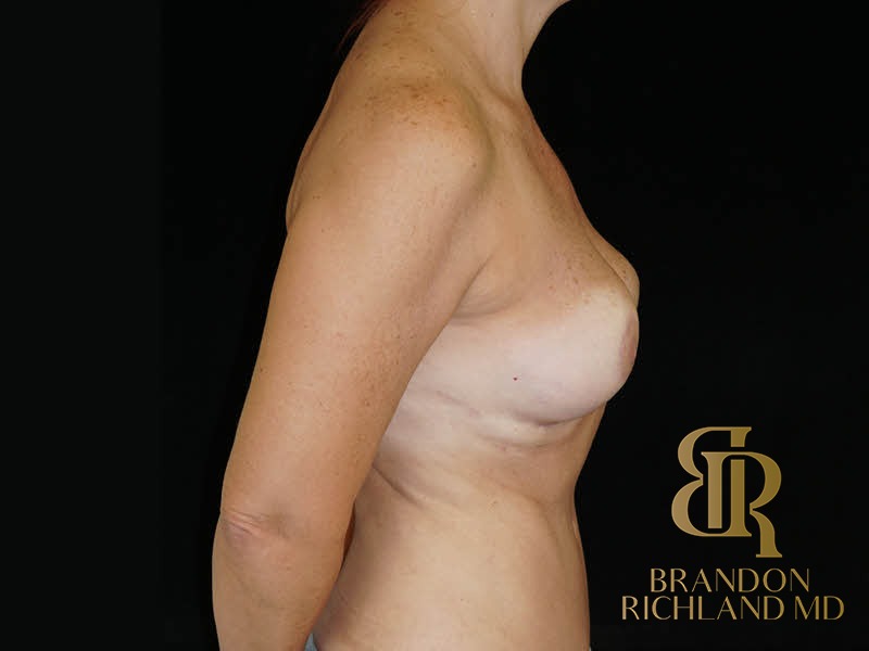 Fat Transfer Breast Augmentation After photo, Patient 04