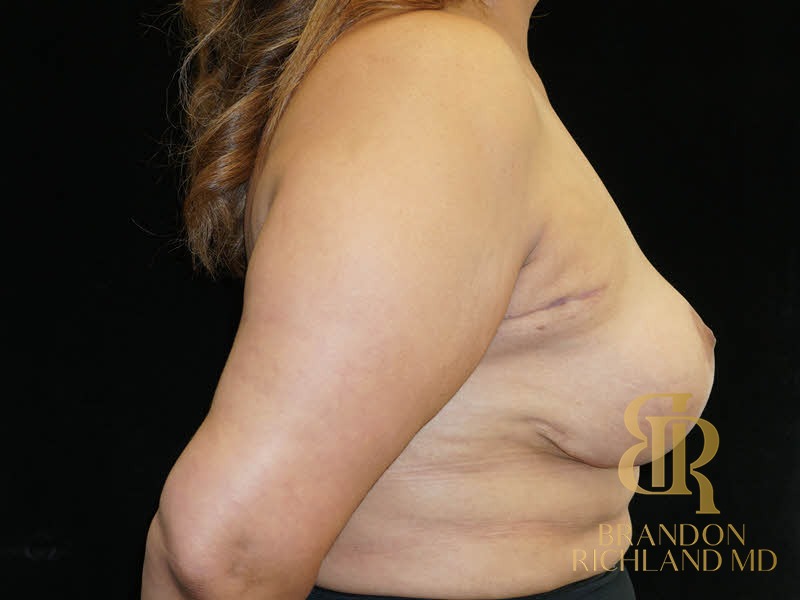 Fat Transfer Breast Augmentation After photo, Patient 06