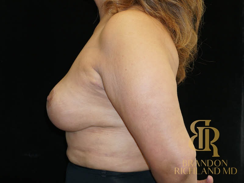 Fat Transfer Breast Augmentation After photo, Patient 06