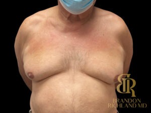 Gynecomastia Surgery before and after, Patient 01 — Dr. Brandon Richland, Newport Beach