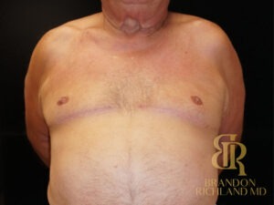 Gynecomastia Surgery before and after, Patient 01 — Dr. Brandon Richland, Newport Beach