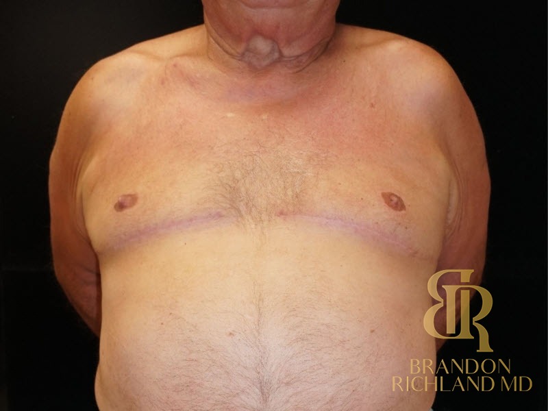 Gynecomastia Surgery After photo, Patient 01