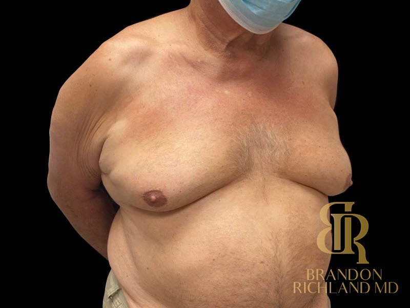Gynecomastia Surgery Before photo, Patient 01
