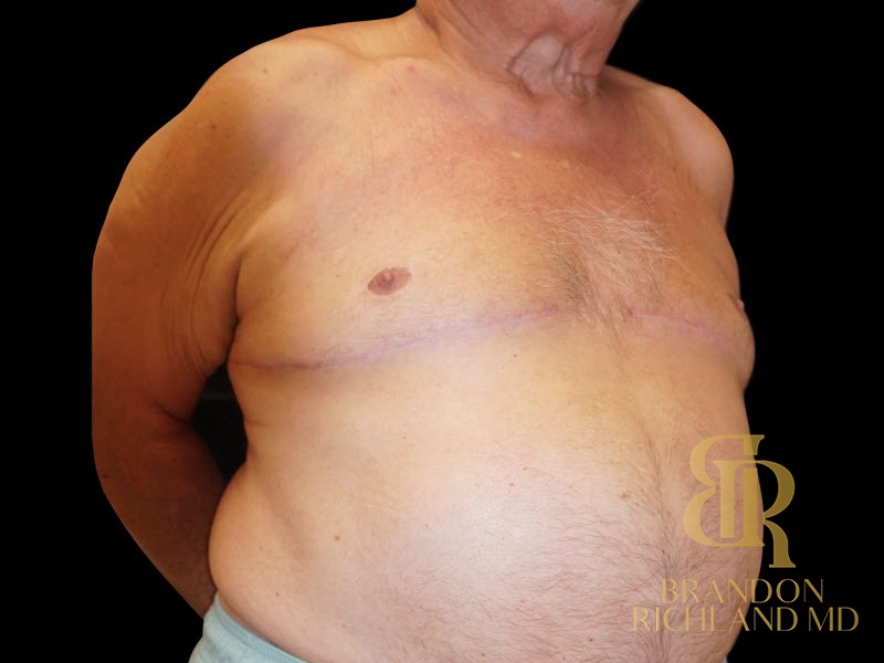 Gynecomastia Surgery After photo, Patient 01