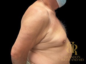 Gynecomastia Surgery before and after, Patient 01 — Dr. Brandon Richland, Newport Beach