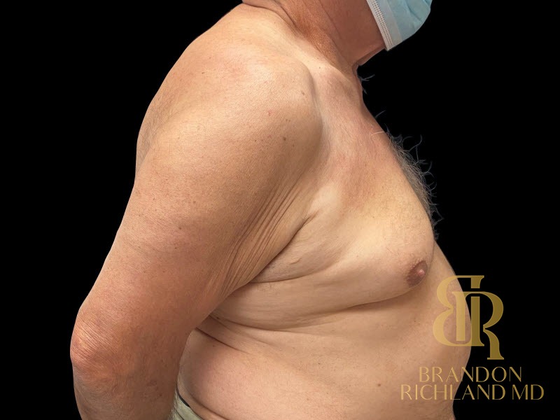 Gynecomastia Surgery Before photo, Patient 01
