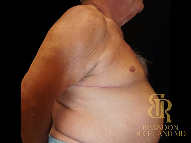 Gynecomastia Surgery After photo, Patient 01