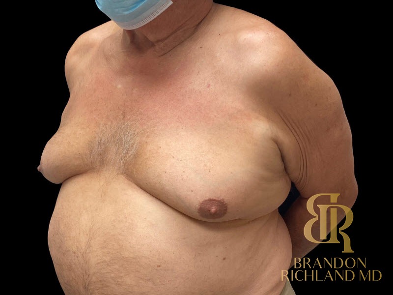 Gynecomastia Surgery Before photo, Patient 01