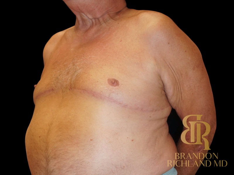 Gynecomastia Surgery After photo, Patient 01