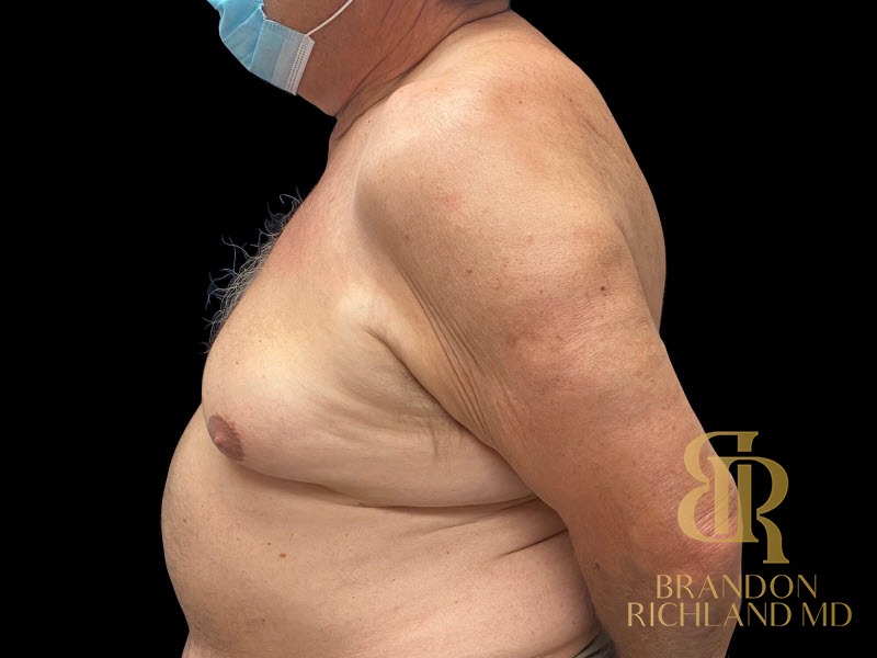 Gynecomastia Surgery Before photo, Patient 01