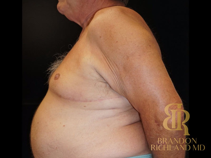 Gynecomastia Surgery After photo, Patient 01