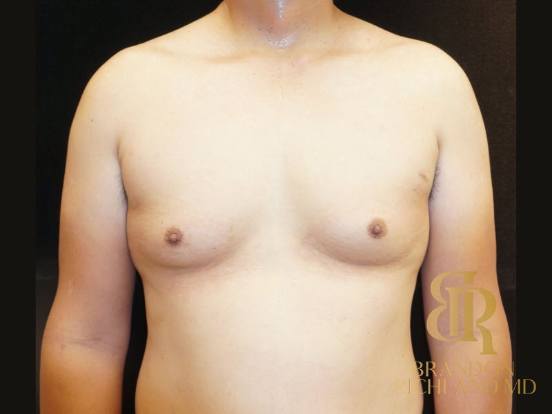 Gynecomastia Surgery Before photo, Patient 02