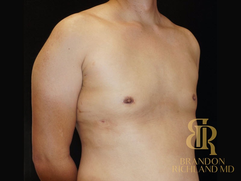 Gynecomastia Surgery After photo, Patient 02