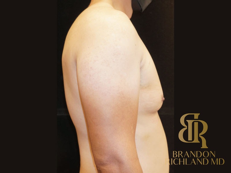 Gynecomastia Surgery Before photo, Patient 02