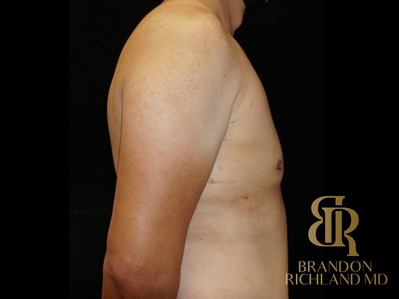 Gynecomastia Surgery After photo, Patient 02