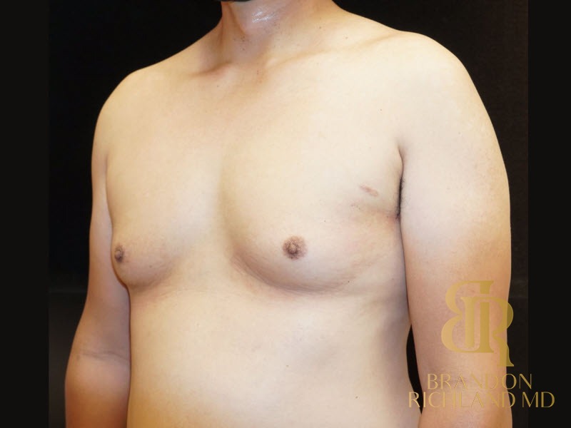 Gynecomastia Surgery Before photo, Patient 02